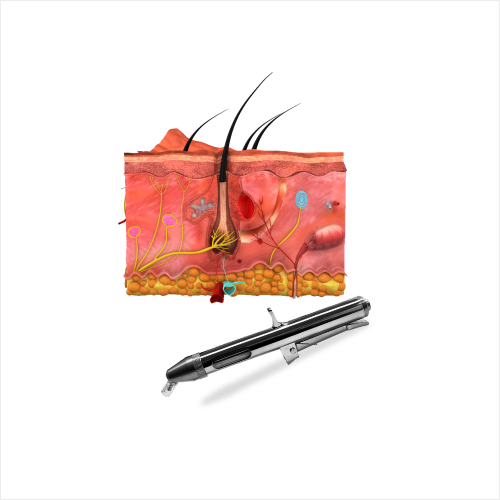 Intralesional Therapy